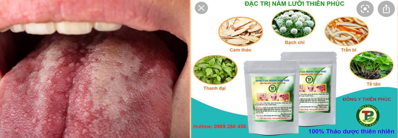 Đặc trị nấm lưỡi Thiên Phúc giúp trị nấm lưỡi hiệu quả 